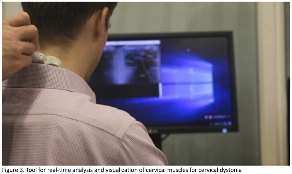 Figure 3. Tool for real-time analysis and visualization of cervical muscles for cervical dystonia