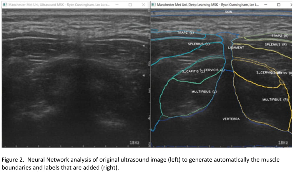 Figure 2.  Neural Network analysis of original ultrasound image (left) to generate automatically the muscle boundaries and labels that are added (right).